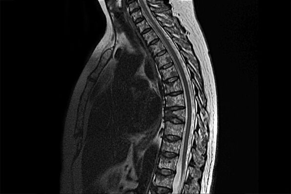 Osteokonondrosaren adierazgarriak MRI irudian