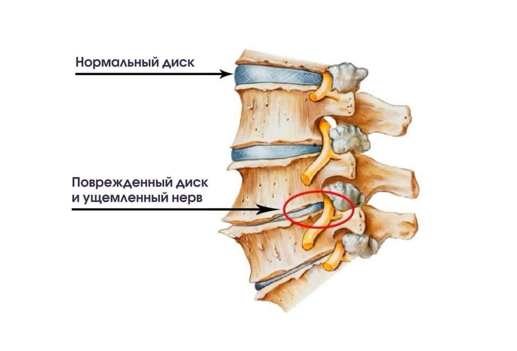Osteokonondrosi cervikalaren sintomak