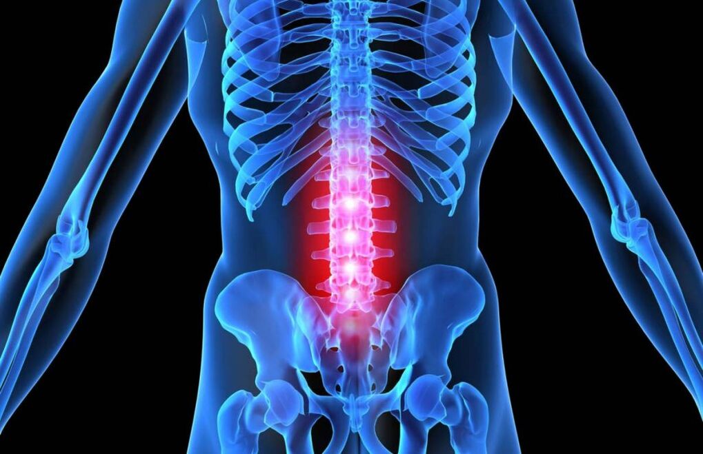 Lumbar bizkarrezurraren osteokondrosia
