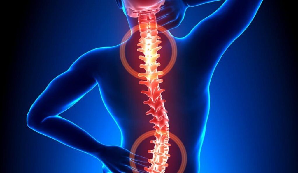 bizkarrezurreko osteokondrosia