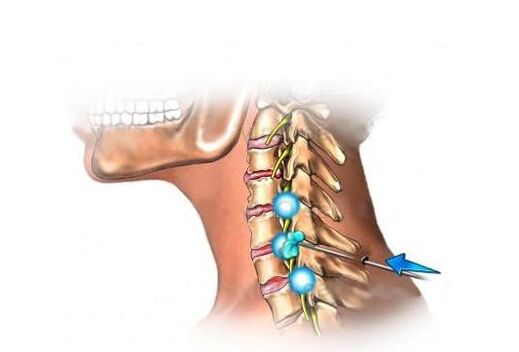 Trápaga osteokondrosiaren tratamendua